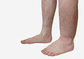 Berantas Nyamuk Untuk Cegah Kaki Gajah